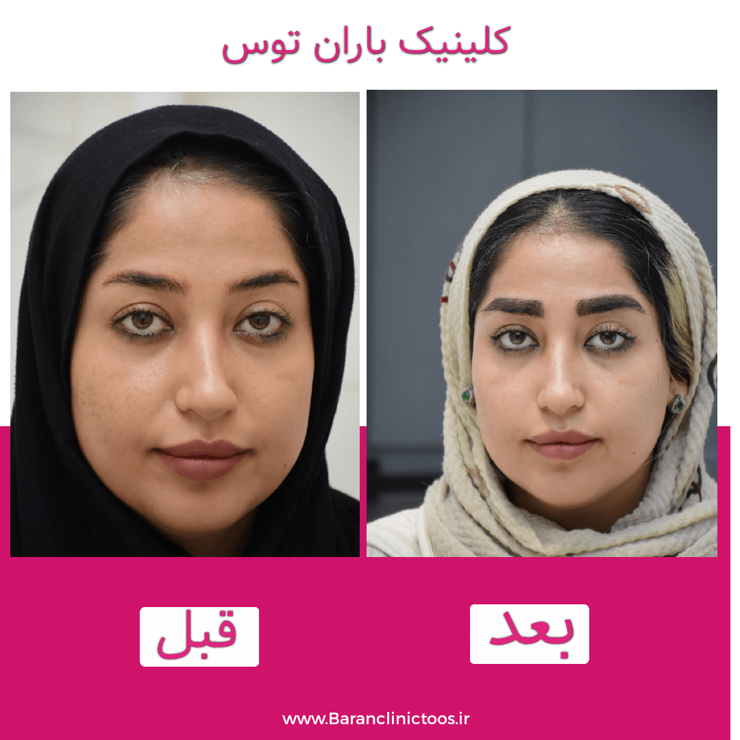 قبل و بعد کاشت ابرو